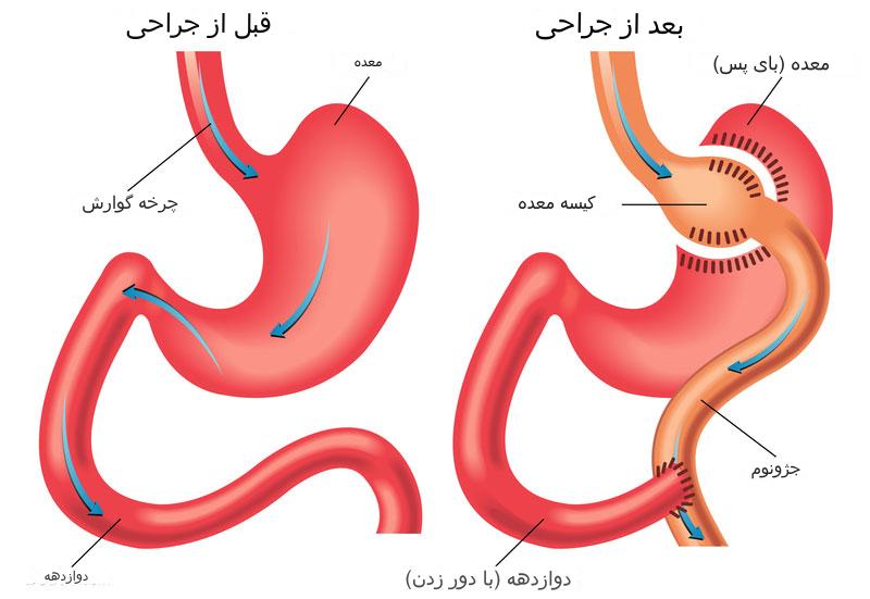 بای پس معده