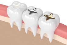 انواع روش پر کردن دندان