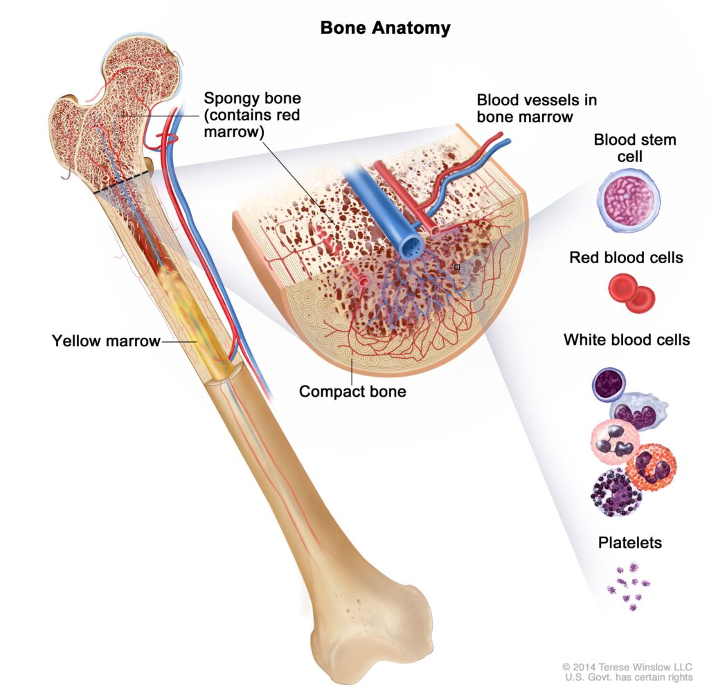 4. acute lymphocytic leukemia ALL