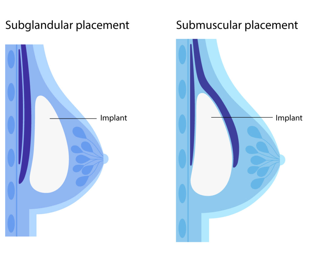 Breast cosmetic surgeries for women