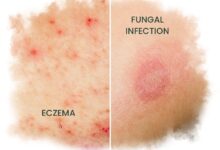 ECZEMA and fungal infection