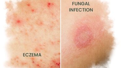 ECZEMA and fungal infection