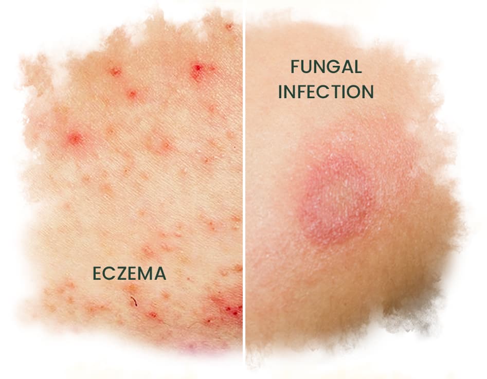 ECZEMA and fungal infection