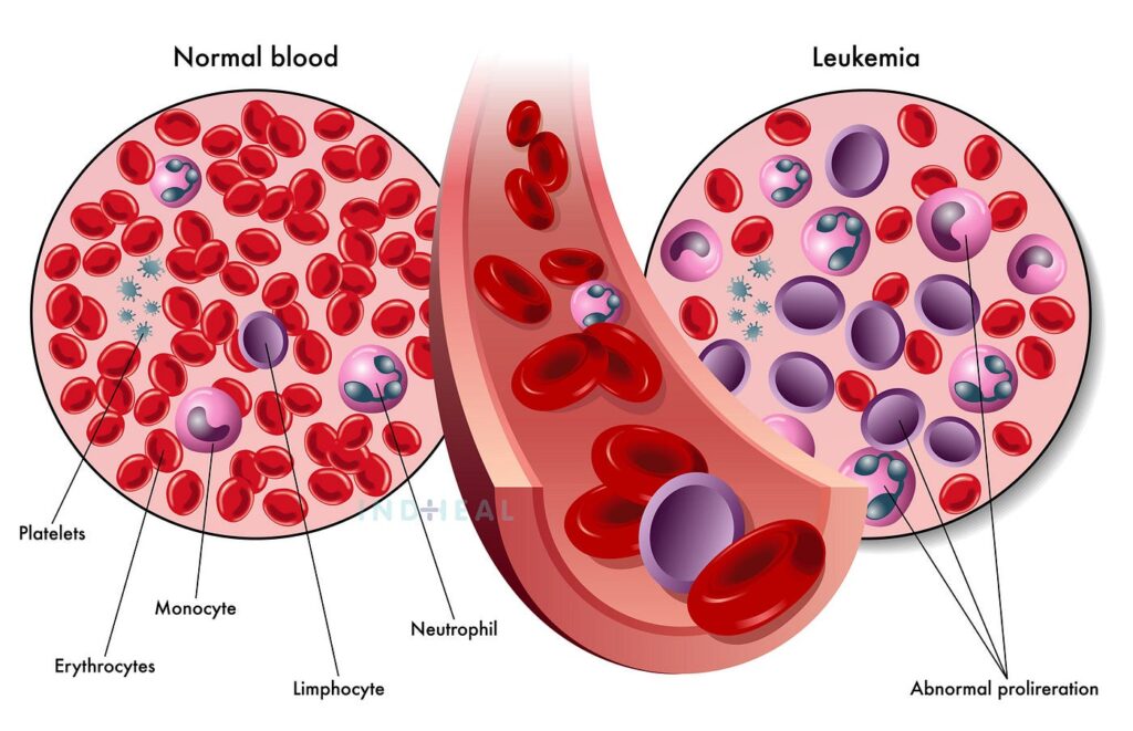 How to prevent blood cancer