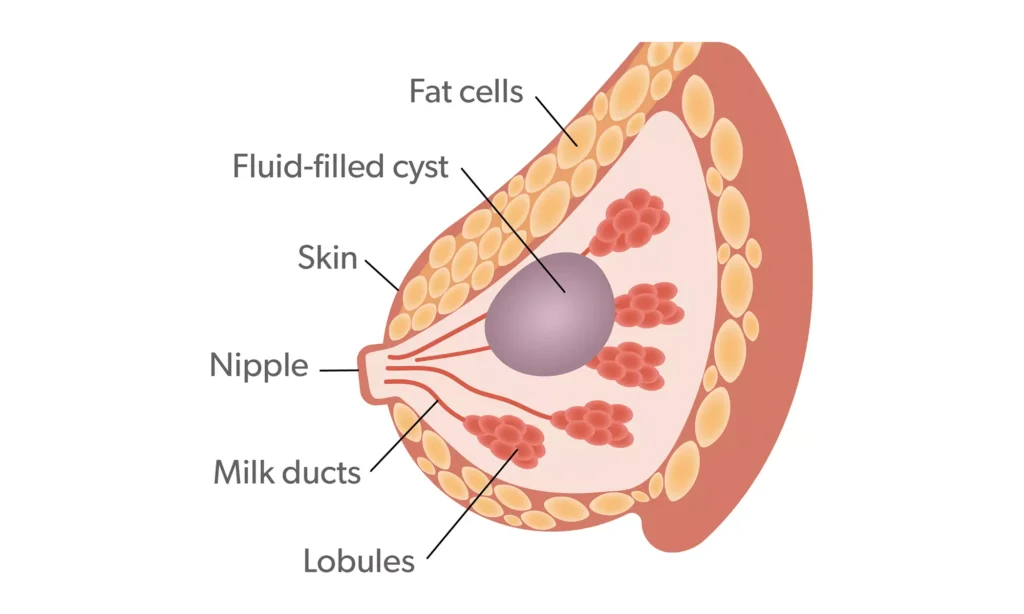 Mammary masses in womens breasts