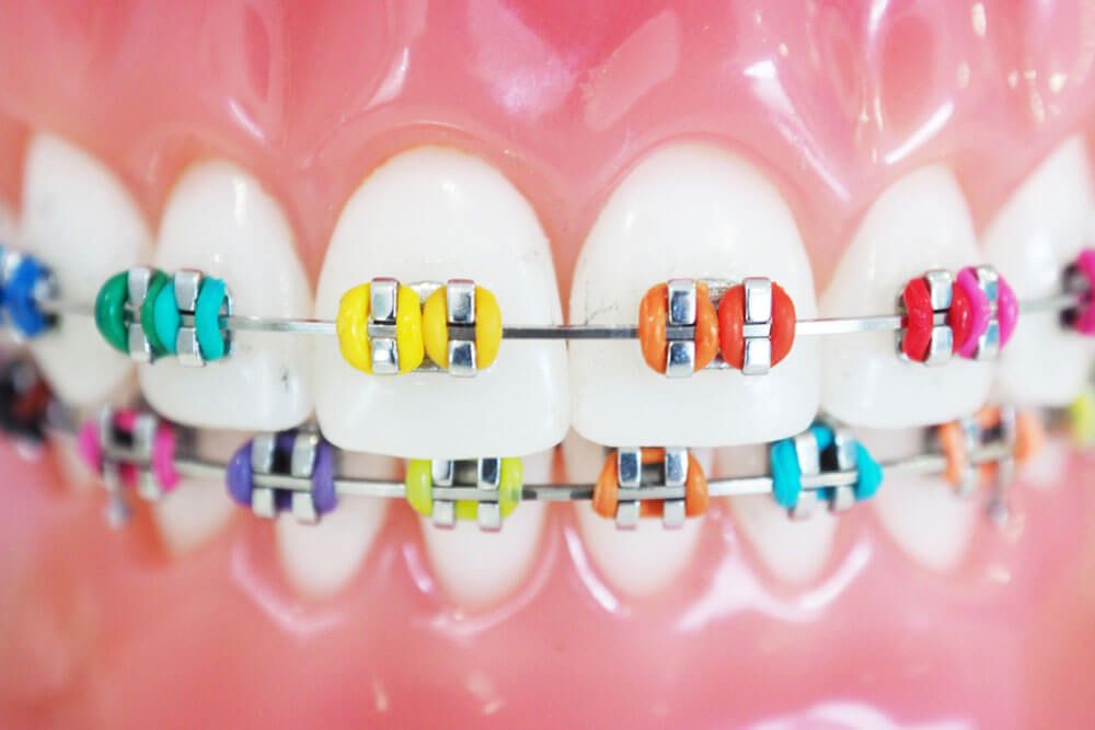 Orthodontic braces