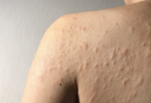 حساسیت پوستی را چگونه می­توان کنترل کرد؟
