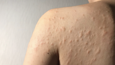 حساسیت پوستی را چگونه می­توان کنترل کرد؟