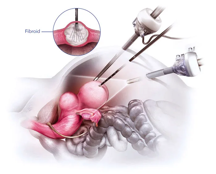 Treatment of uterine fibroids