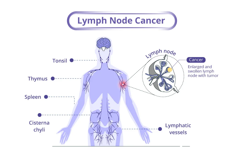 Types of lymphoid cancer