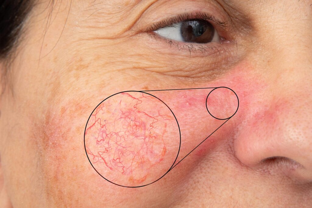 Varicose veins of the face