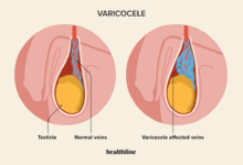 بیماری واریکوسل چیست ؟ علل، علائم و تاثیر در ناباروری مردان