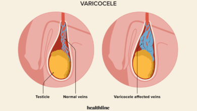 بیماری واریکوسل چیست ؟ علل، علائم و تاثیر در ناباروری مردان