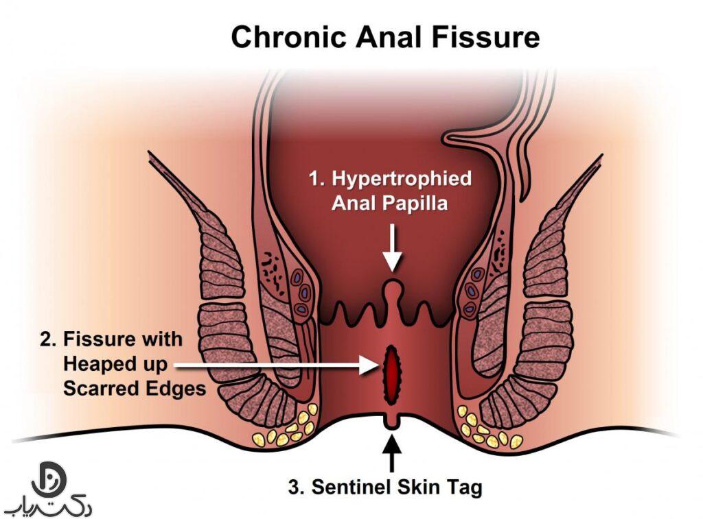 Anal fissure