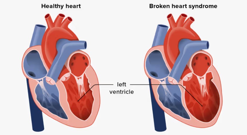 Broken heart syndrome5