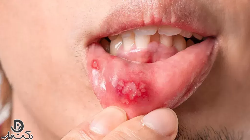 Canker sores