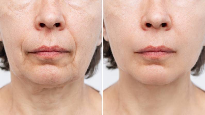 Duration of face lift