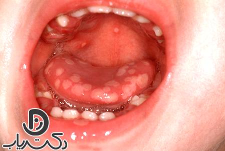 Gingivomatitis