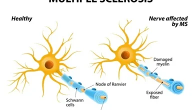 بیماری ام اس MS ; علائم و راه های درمان آن