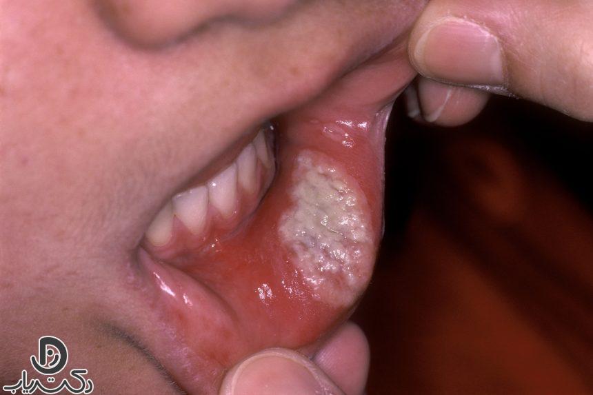 Oral celiac disease