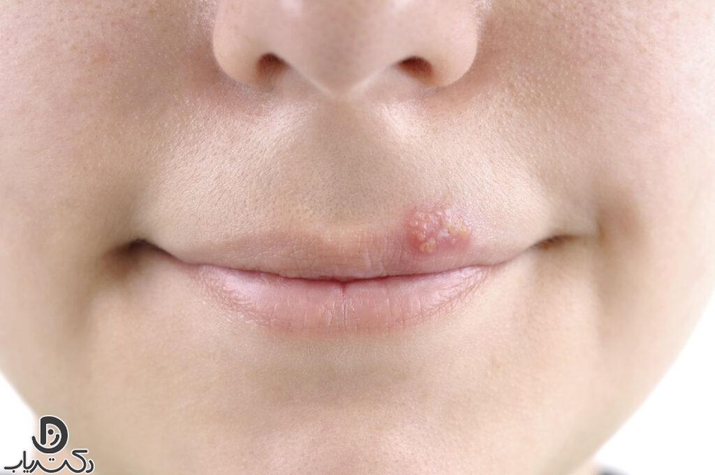 Prevention of mouth and lip blisters