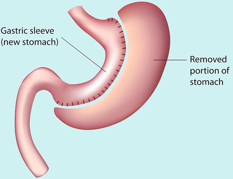 Stomach sleeve