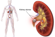 درمان سنگ کلیه : روش های خانگی و پزشکی