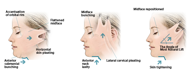 Types of face lift methods