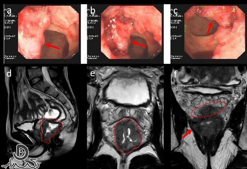 Using MRI instead of colonoscopy