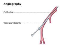 انواع آنژیوگرافی ; آمادگی و نحوه انجام آن
