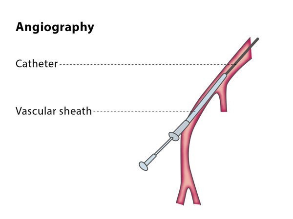انواع آنژیوگرافی ; آمادگی و نحوه انجام آن
