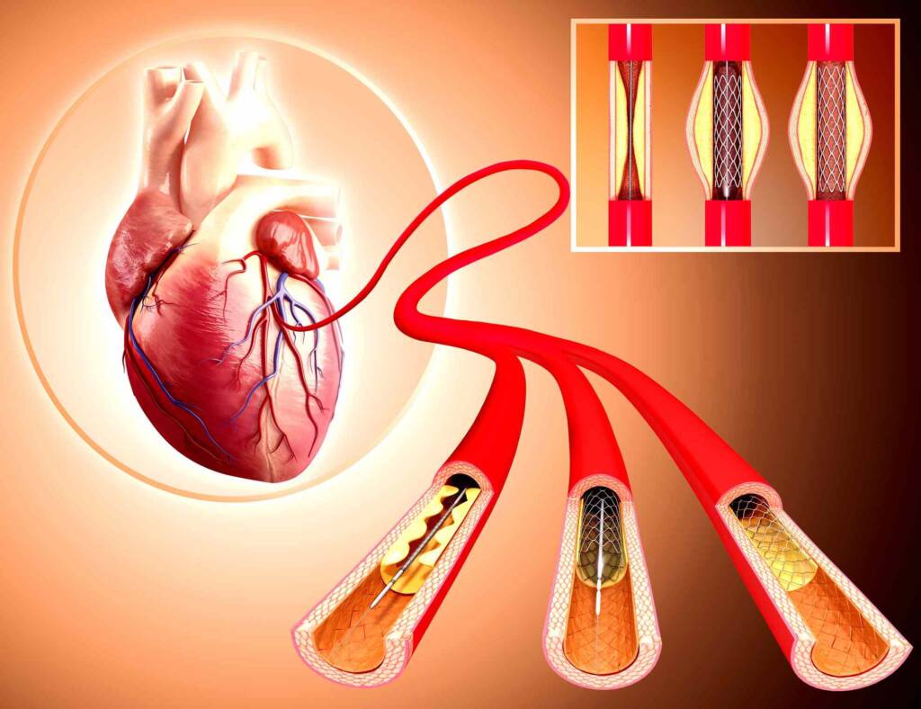 مراحل آنژیوگرافی: در آنژیوگرافی چه اتفاقی می افتد؟