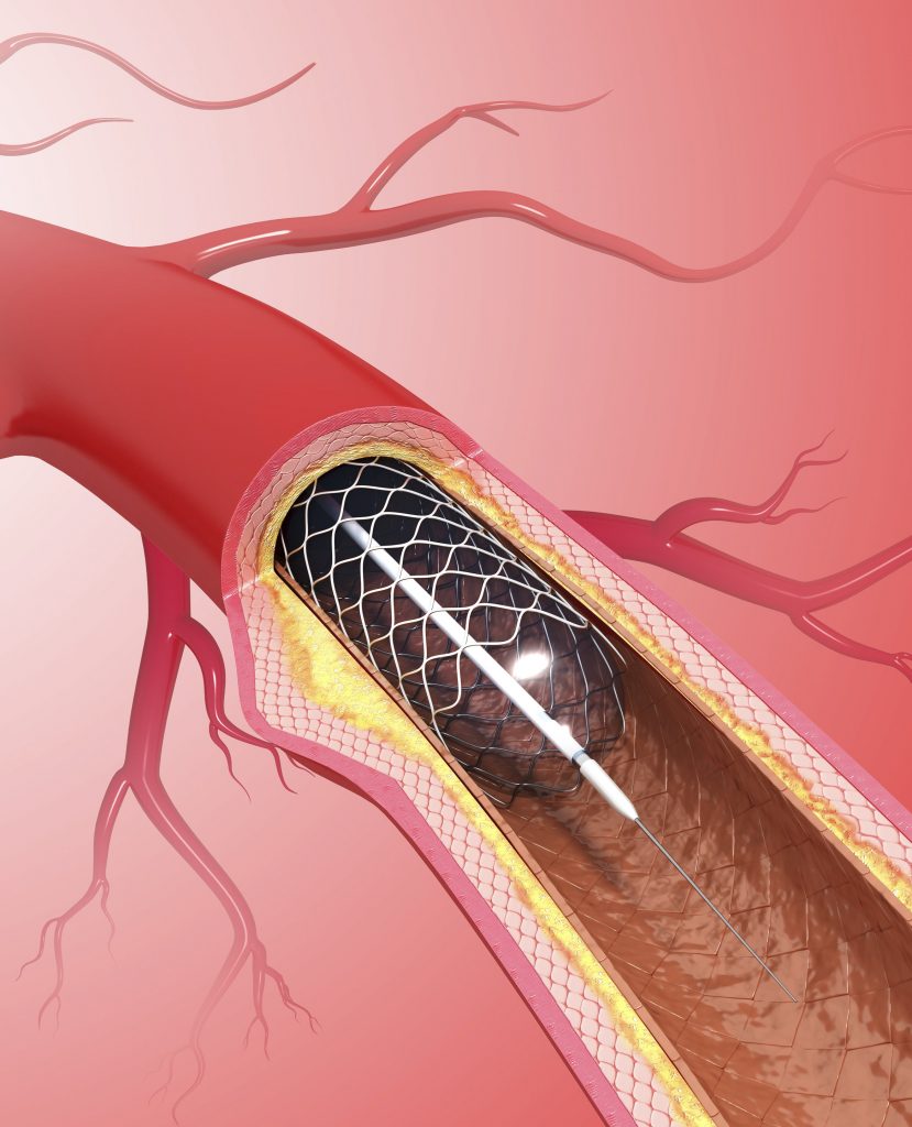 angiography7