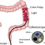 عمل کولونوسکوپی چیست؟ کاربرد و عوارض آن