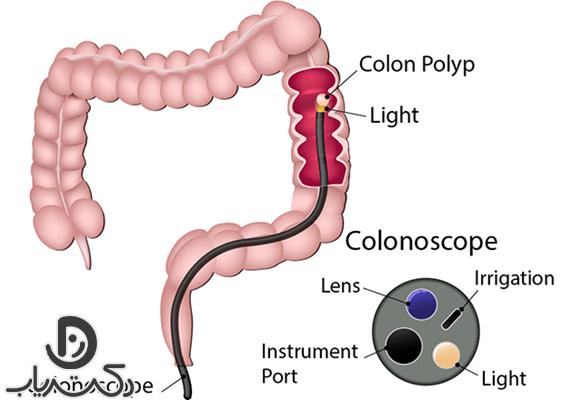عمل کولونوسکوپی چیست؟ کاربرد و عوارض آن