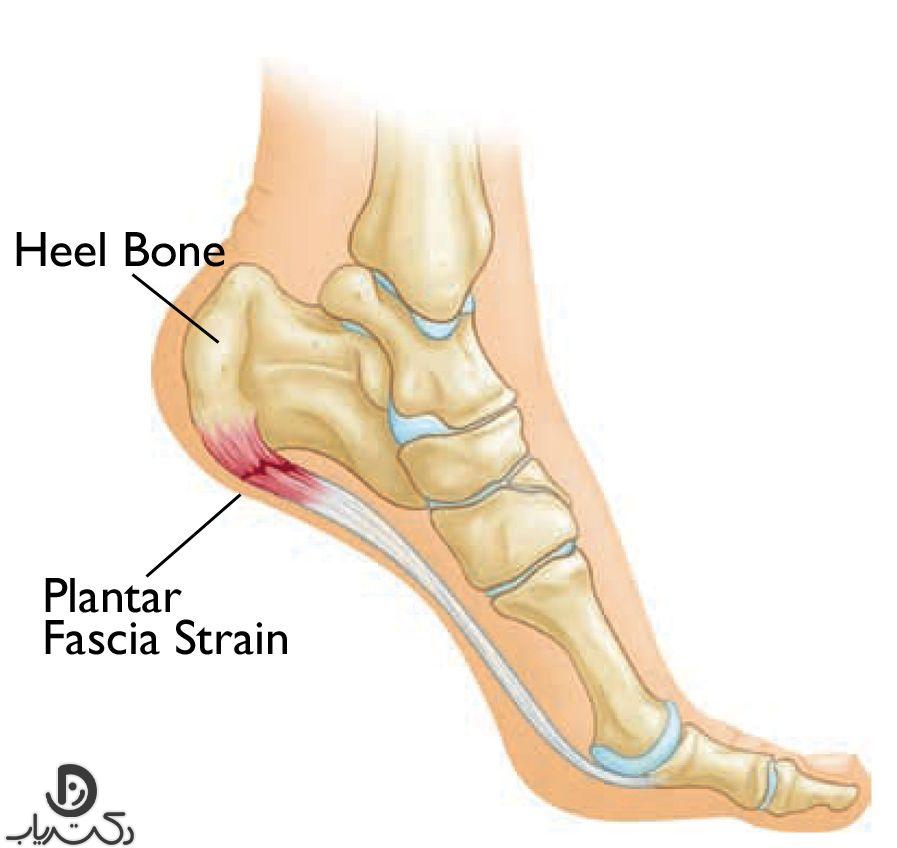 heel spur