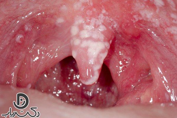 oral thrush