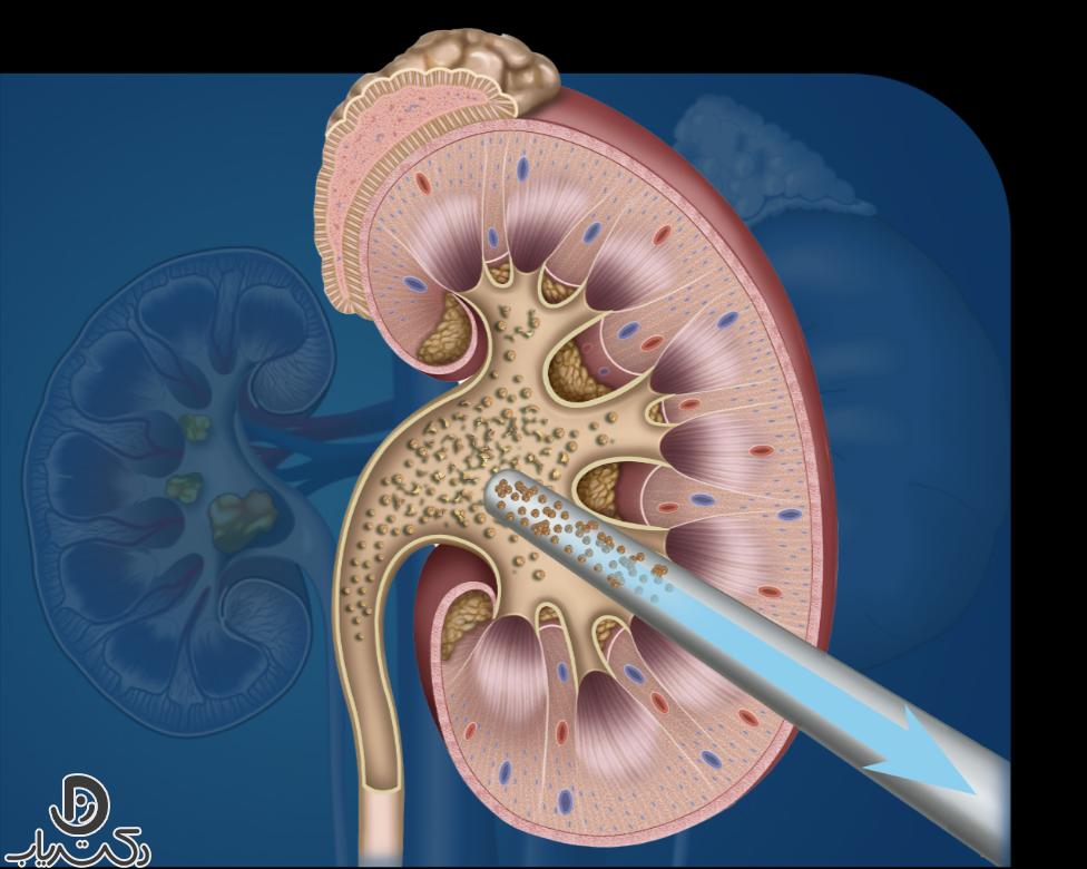 percutaneous nephrolithotomy PCNL