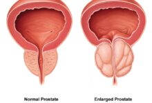 پروستات چیست ؟ علائم خطرناک و درمان آن
