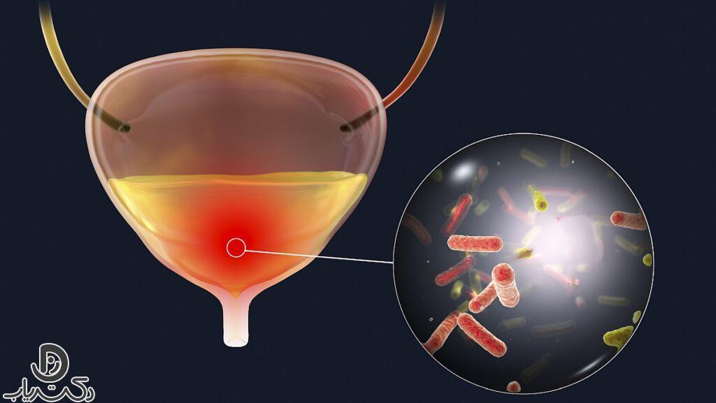 خطرات عدم درمان عفونت مثانه