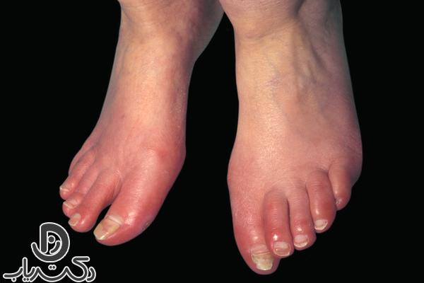 Erythromelalgia disease