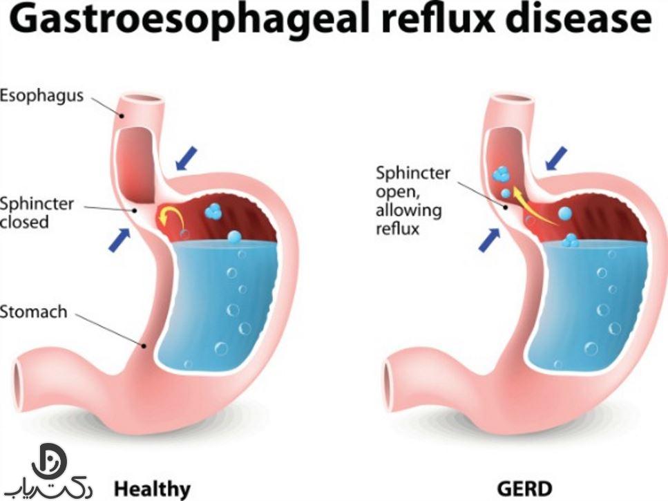 علائم رفلاکس معده چیست ؟