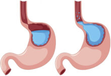 رفلاکس معده چیست ؟ علل، علائم و روش های درمان آن