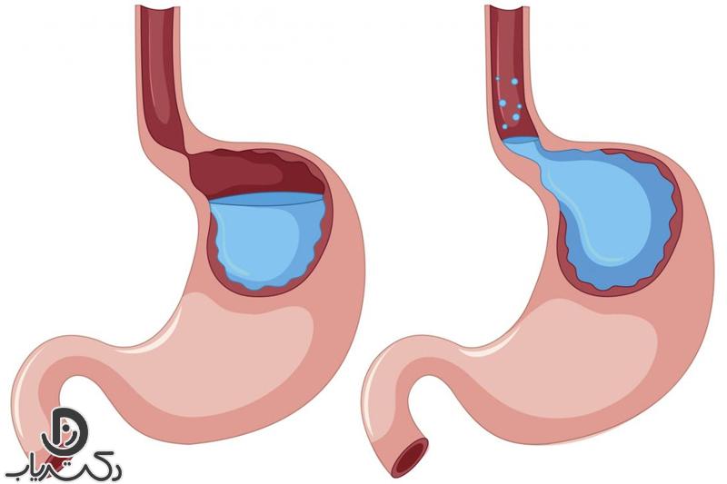 رفلاکس معده چیست ؟ علل، علائم و روش های درمان آن