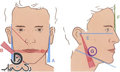 کاربردهای تزریق ژل در زاویه سازی فک