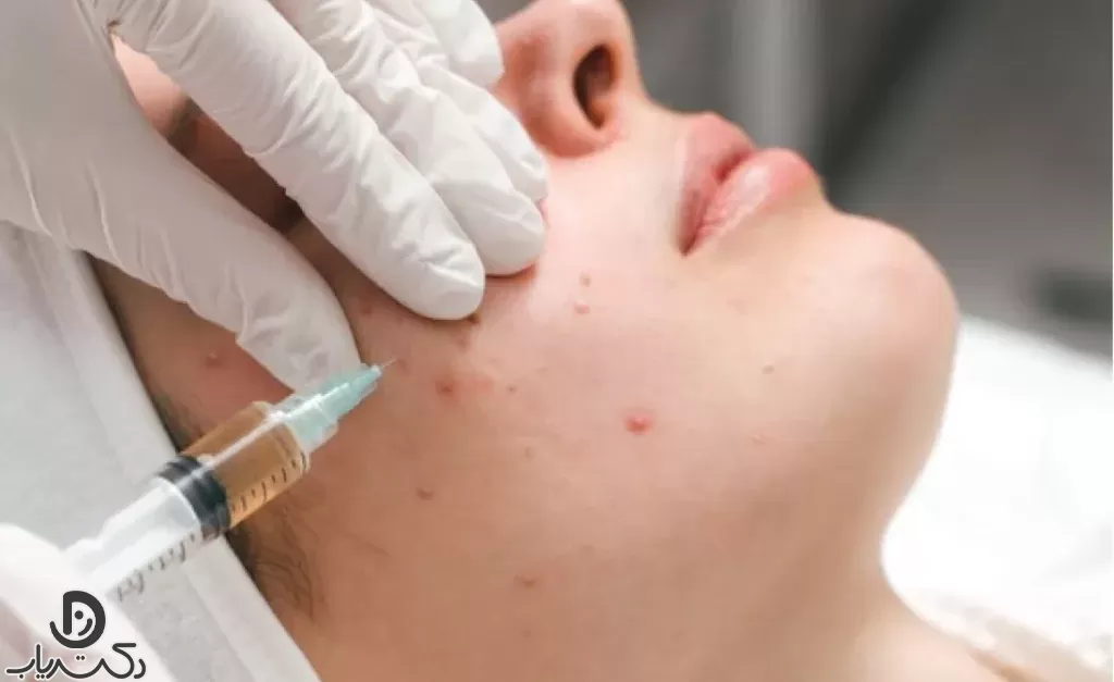 PRP face to remove pimples