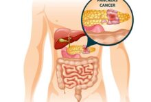 علائم سرطان پانکراس : راه های درمان آن