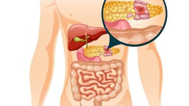 علائم سرطان پانکراس : راه های درمان آن