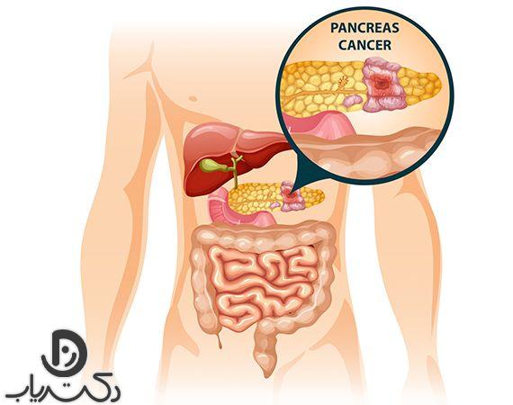 علائم سرطان پانکراس : راه های درمان آن