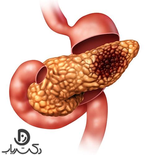 دلیل بروز سرطان لوزالمعده چیست؟